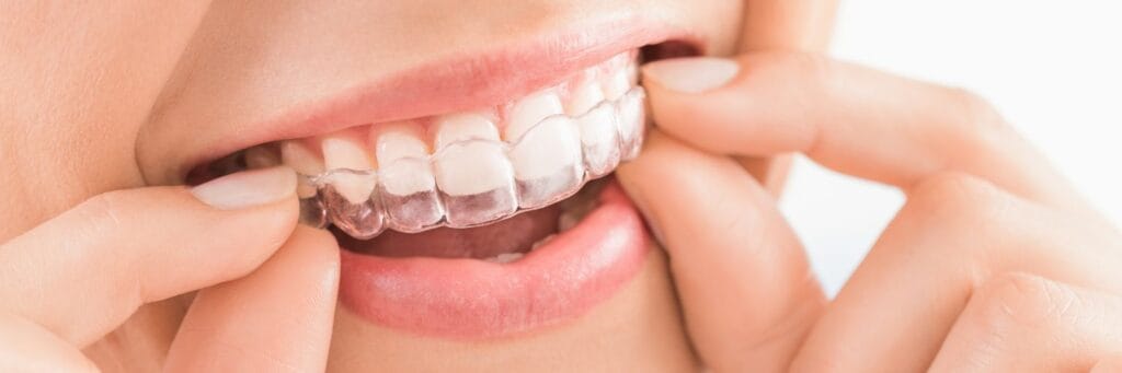 Invisalign Miralbueno