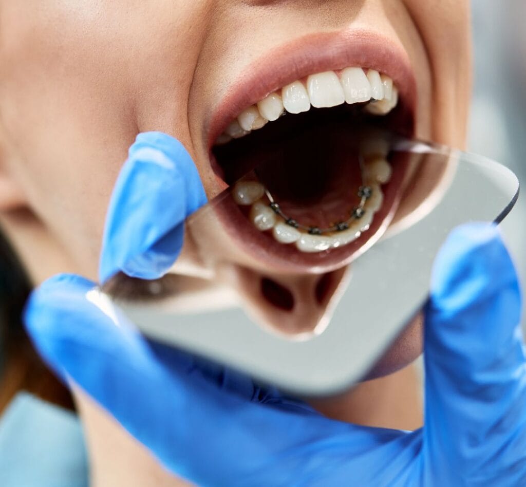 brackets linguales