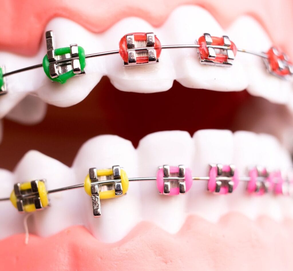 Brackets Metálicos