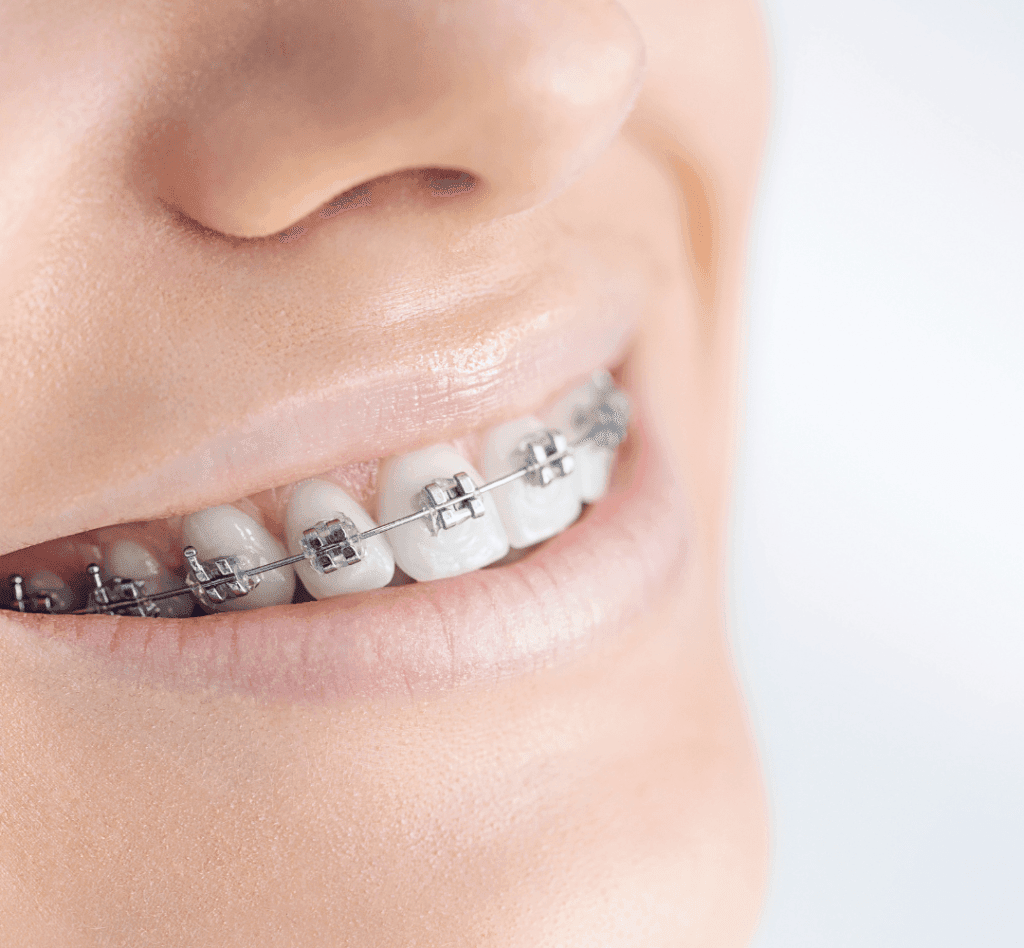 brackets Autoligables Miralbueno