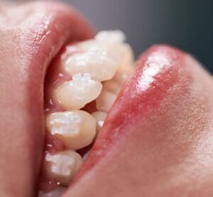 brackets cerámica miralbueno