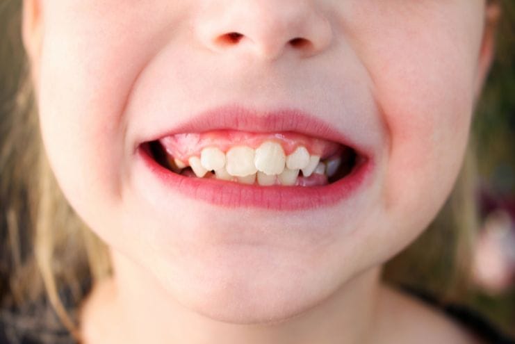 dientes apiñados