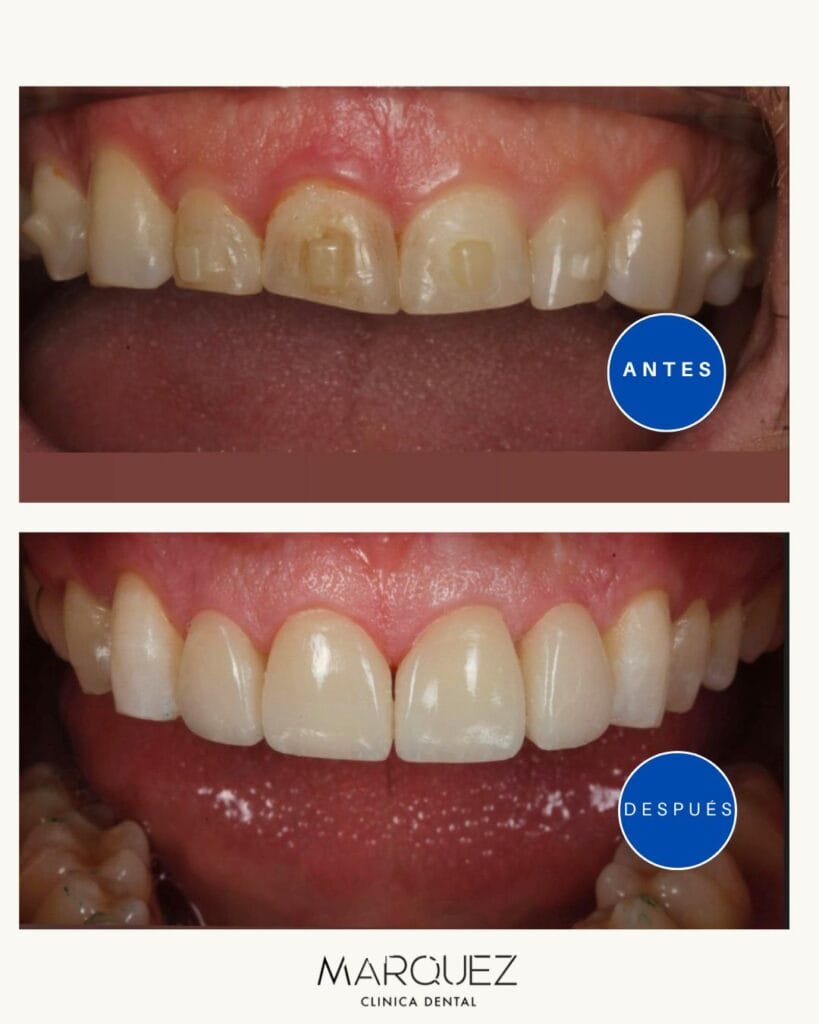 caso real ortodoncia adulto