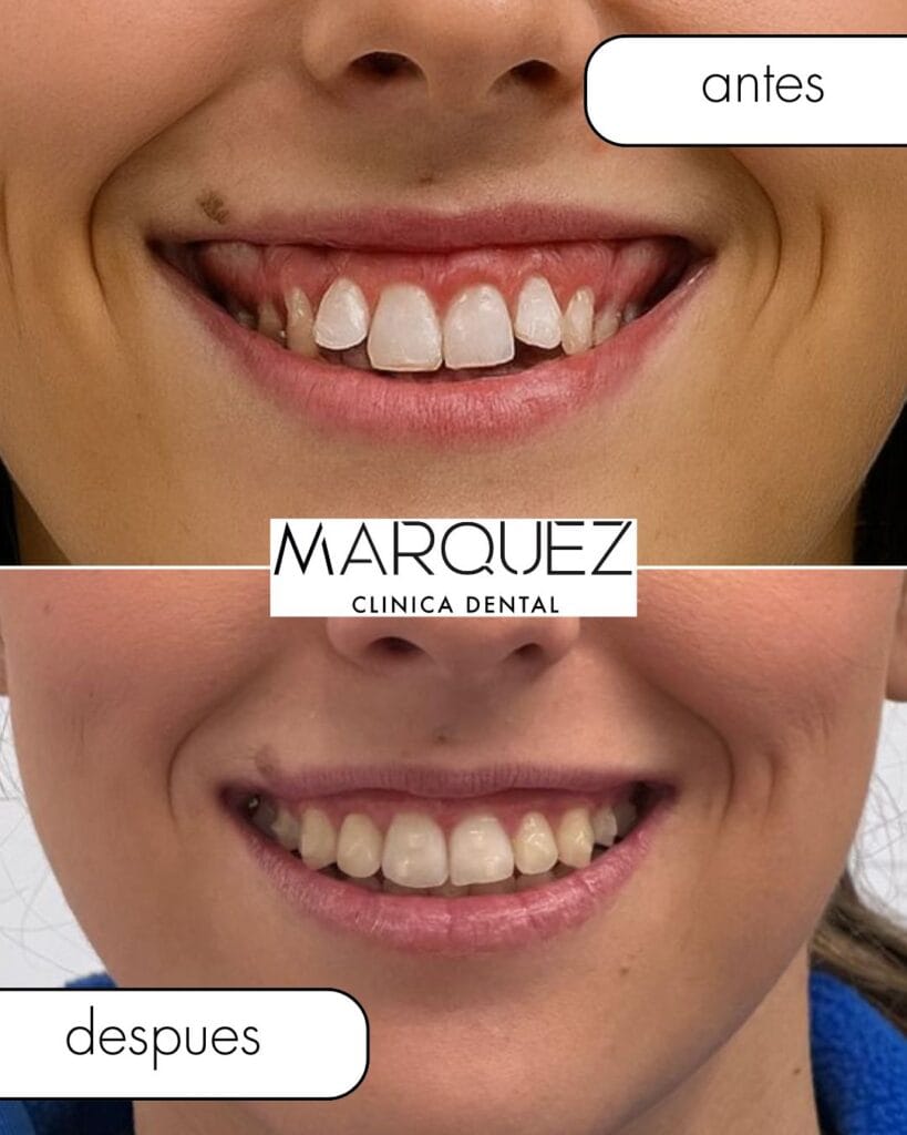 caso real ortodoncia adulto