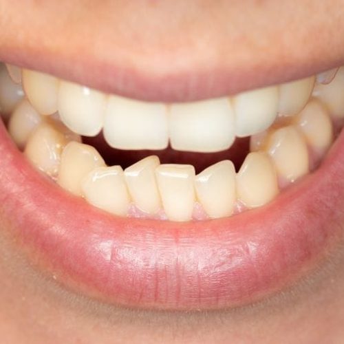 dientes apiñados abajo